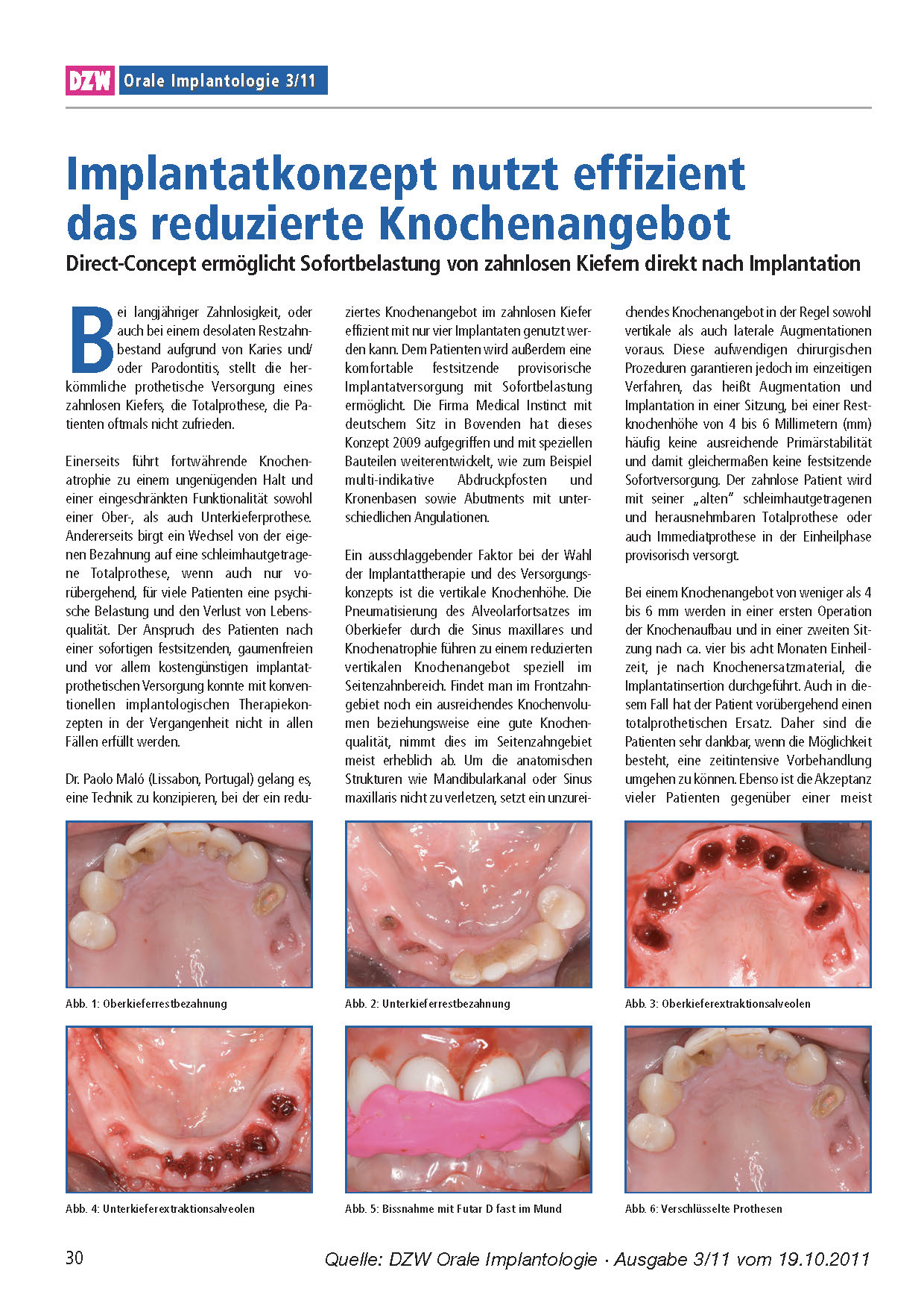 DZW - Implantatkonzept Nutzt Effizient Das Reduzierte Knochenangebot DZW Ausgabe 3 11